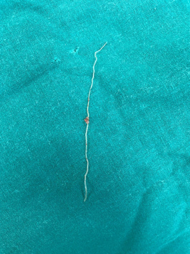 12-сантиметровый червь поселился в щеке женщины после укуса комара