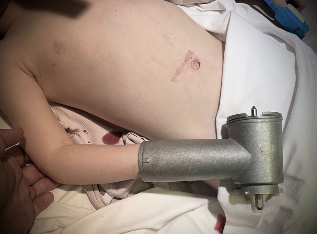В Воронеже трёхлетний ребёнок засунул руку в мясорубку&nbsp;