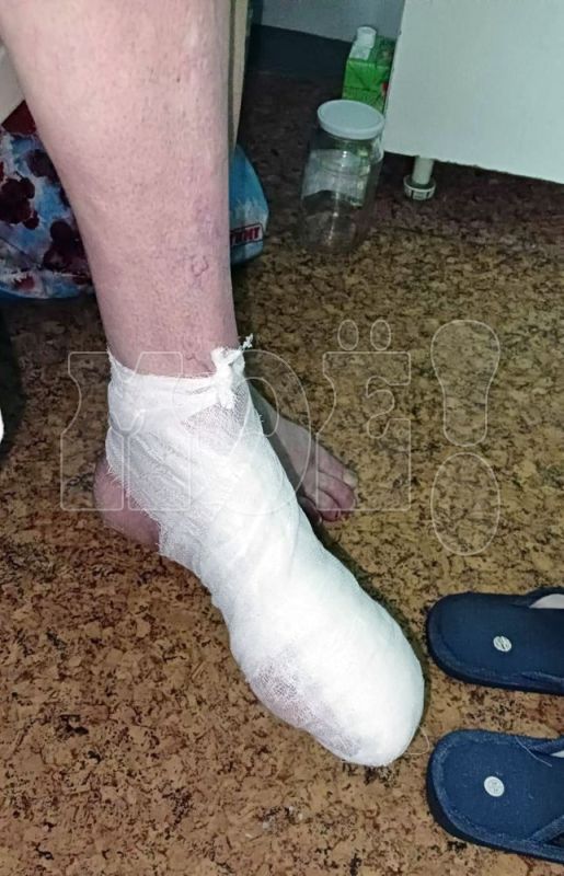 <p>Нога получившей травму женщины</p>