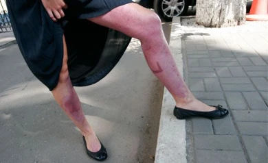 В Воронеже во время занятий по вождению модель получила ожоги 2-й и 3-й степени