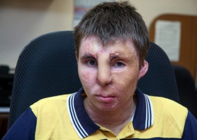 Нижегородские врачи пытаются вернуть 16-летнему воронежцу лицо