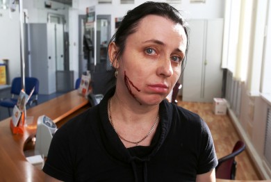 Банк извинился перед жительницей Воронежа, которой в щёку воткнули ручку